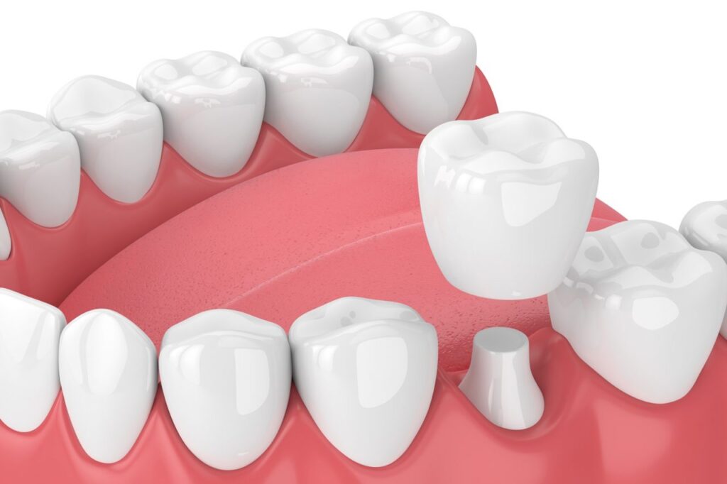 Evergreen Dental Zahnkronen