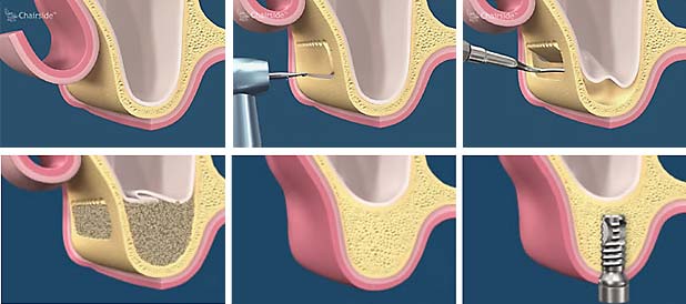 Sinus-lift
